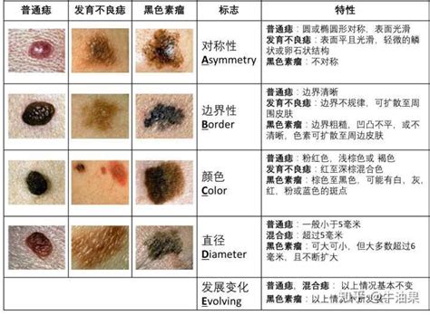 手臂有黑痣|我的痣会变成黑色素瘤吗？大量图例看完就懂